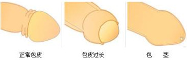 金华男科：包皮术前你应做好的“功课”