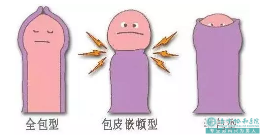 金华包皮过长,谈什么甜蜜幸福了