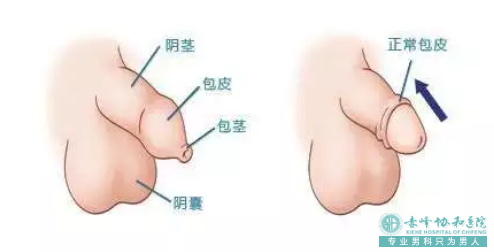 金华金东区男人包皮过长怎么处理较好呢
