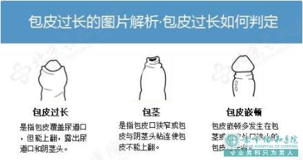金华浙江金华做完包皮手术后有后遗症吗