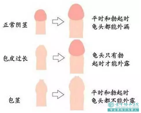 金华敖汉旗包皮包茎的原因都有哪些